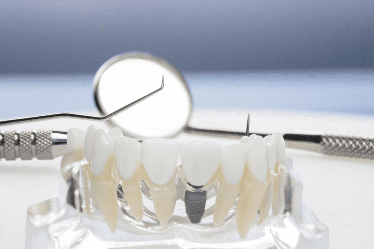 Противопоказания к имплантации зубов: кому нельзя делать имплантацию