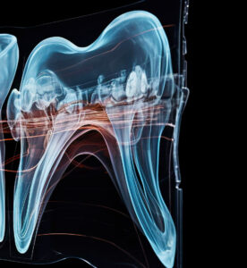 Лечение каналов зуба 