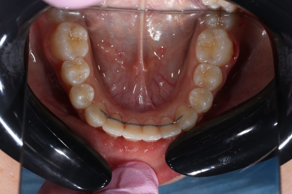 пациент после ортодонтического лечения
