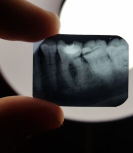 Прицельный снимок зуба 