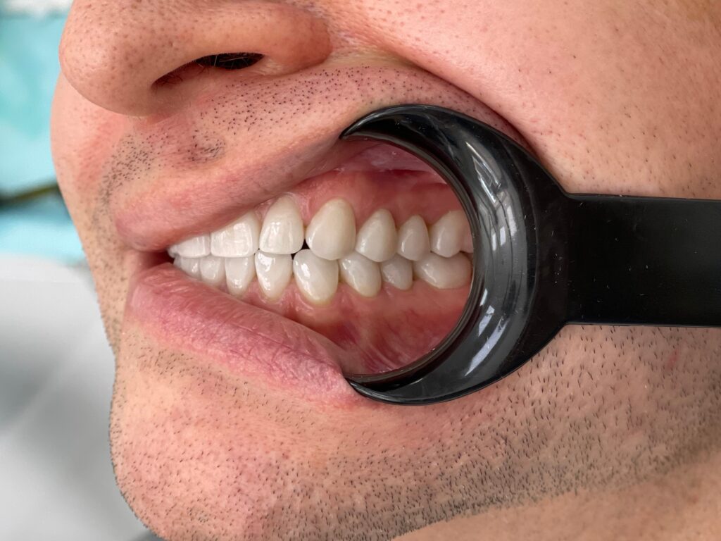 Результат реставрации зубов