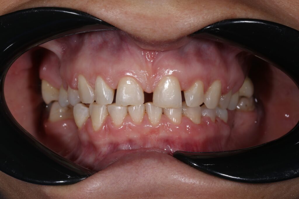 Ортодонтическое лечение перед тотальным протезированием