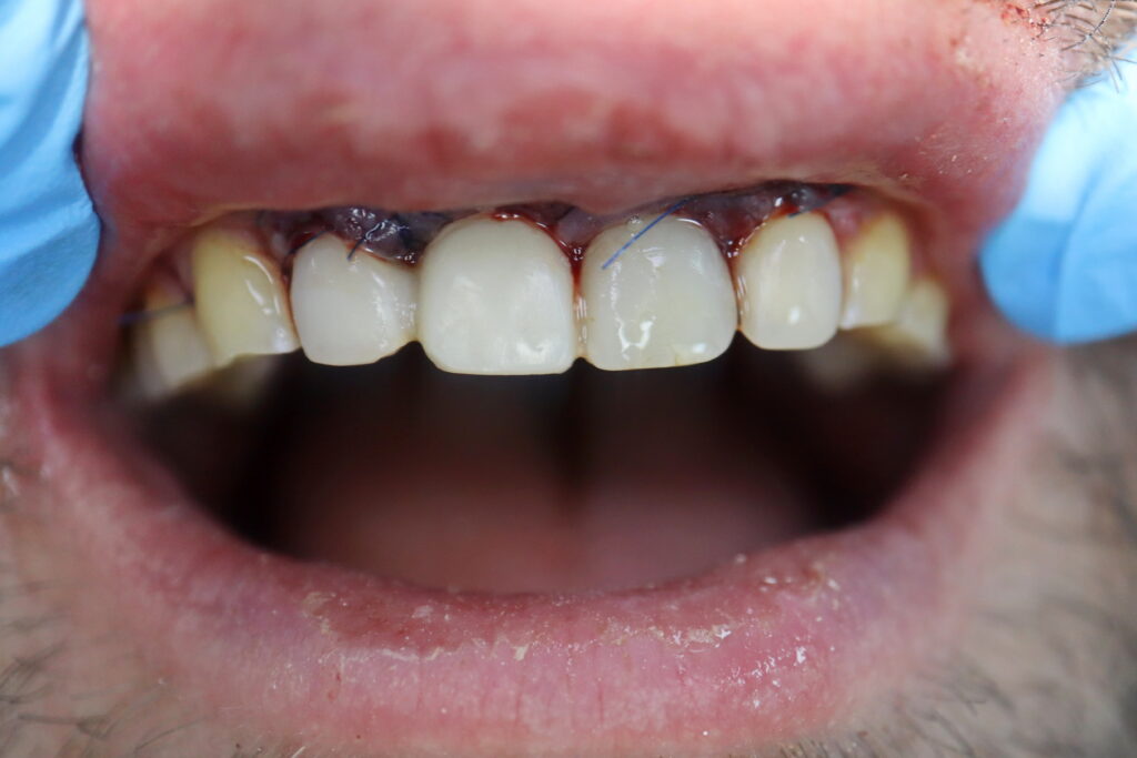 Замена переднего зуба с переломом корня 1.1 на дентальный имплантат Straumann