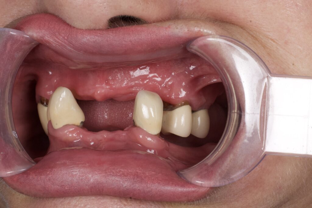 пациент до протезирования