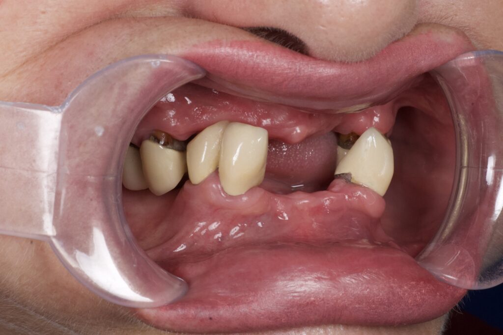 пациент до протезирования