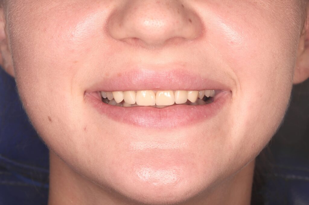 результат протезирования