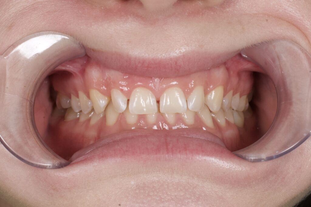 пациент до протезирования