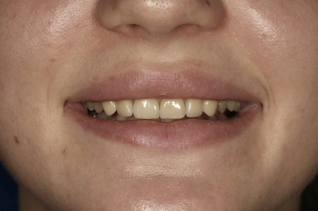 Керамические коронки E.max для коррекции формы и промежутков между зубами