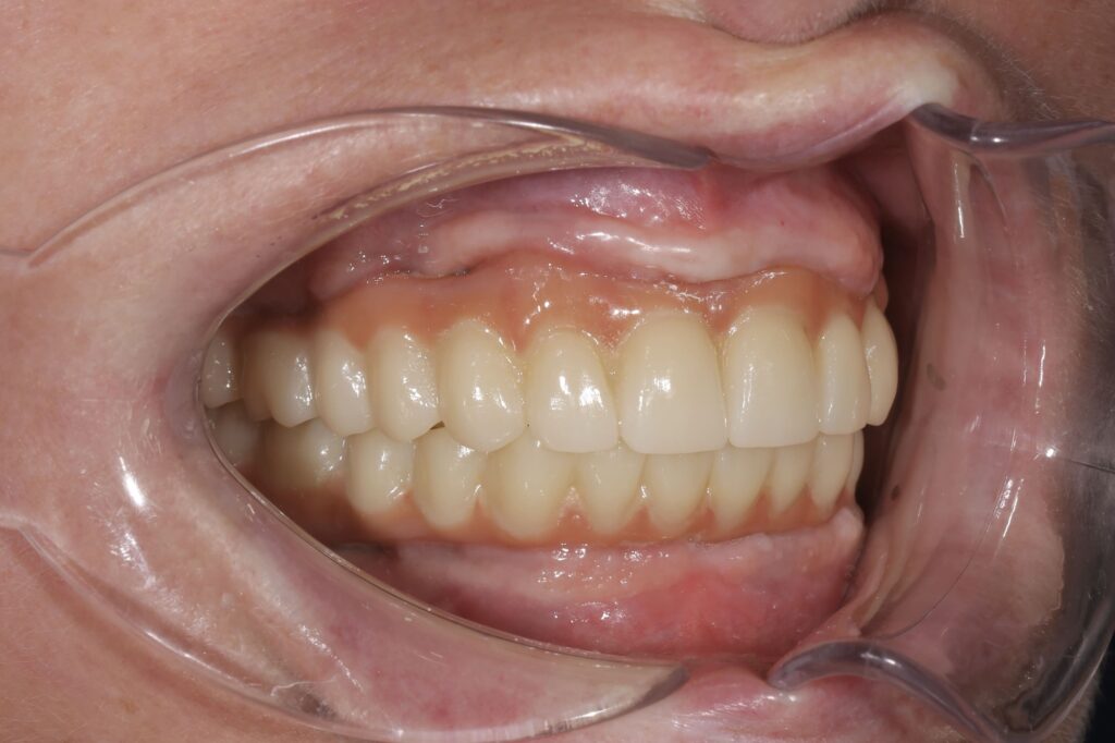 пациент до протезирования