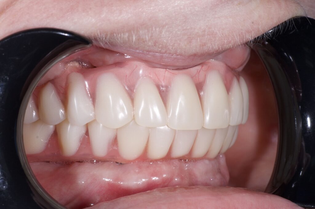 результат протезирования