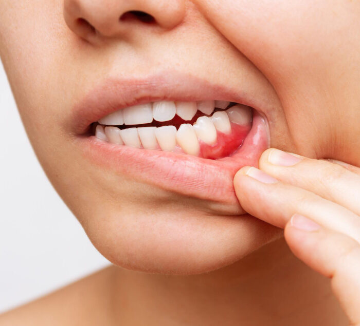 Лечение гингивита в Минске