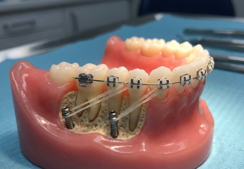 Установка ортодонтических миниимплантов в Минске